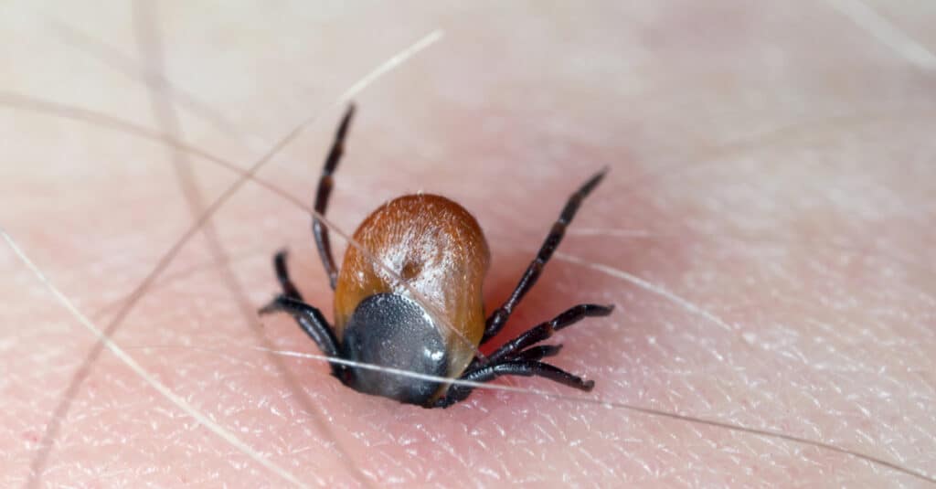 Una zecca di cervo con i suoi cheliceri attaccati alla pelle umana.