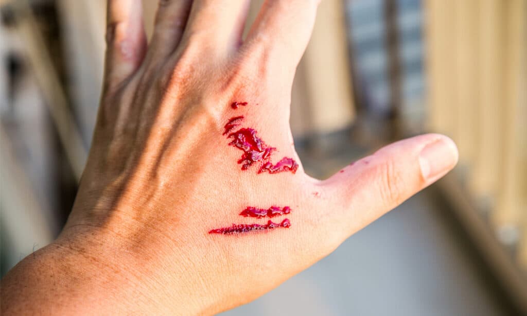Mano umana con ferite da un morso di cane