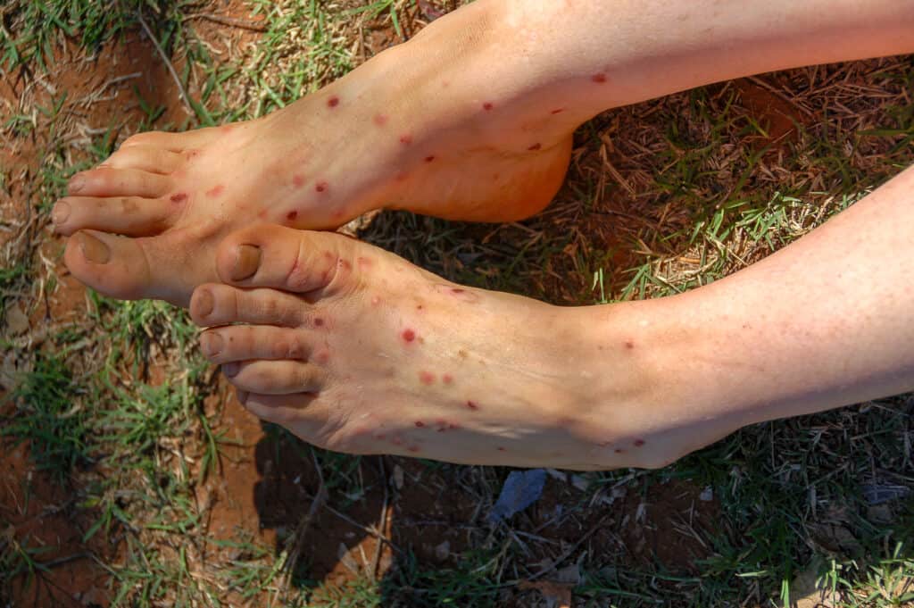 fornito dal fotografo: Piedi e gambe di una donna con morsi di moscerino, morsi da centinaia di moscerini (o pappataci) nell'Australia occidentale.  Le sue gambe e i suoi piedi sono di colore molto chiaro con molte macchie rosse su di essi.  Il suo secondo dito è il più lungo sul piede Esch.  Lo sfondo è erba tagliata da vicino.