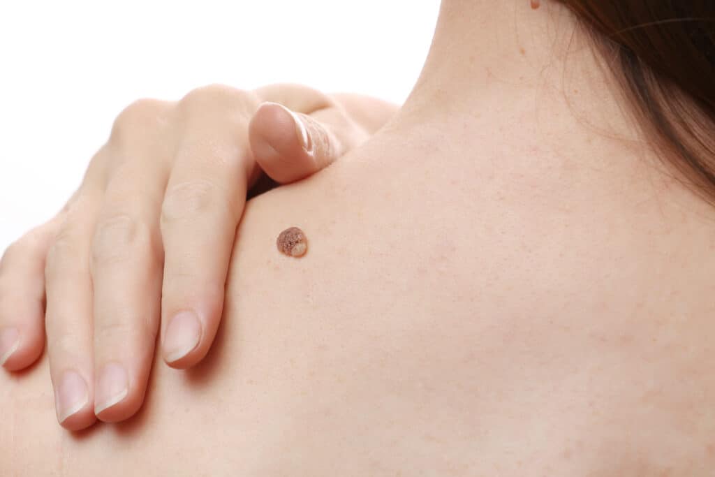 verruca sulla schiena di una donna