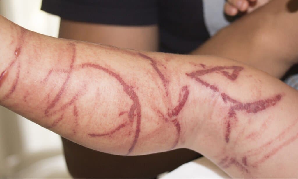 Le meduse più letali del mondo - Box Jellyfish Sting on Human 