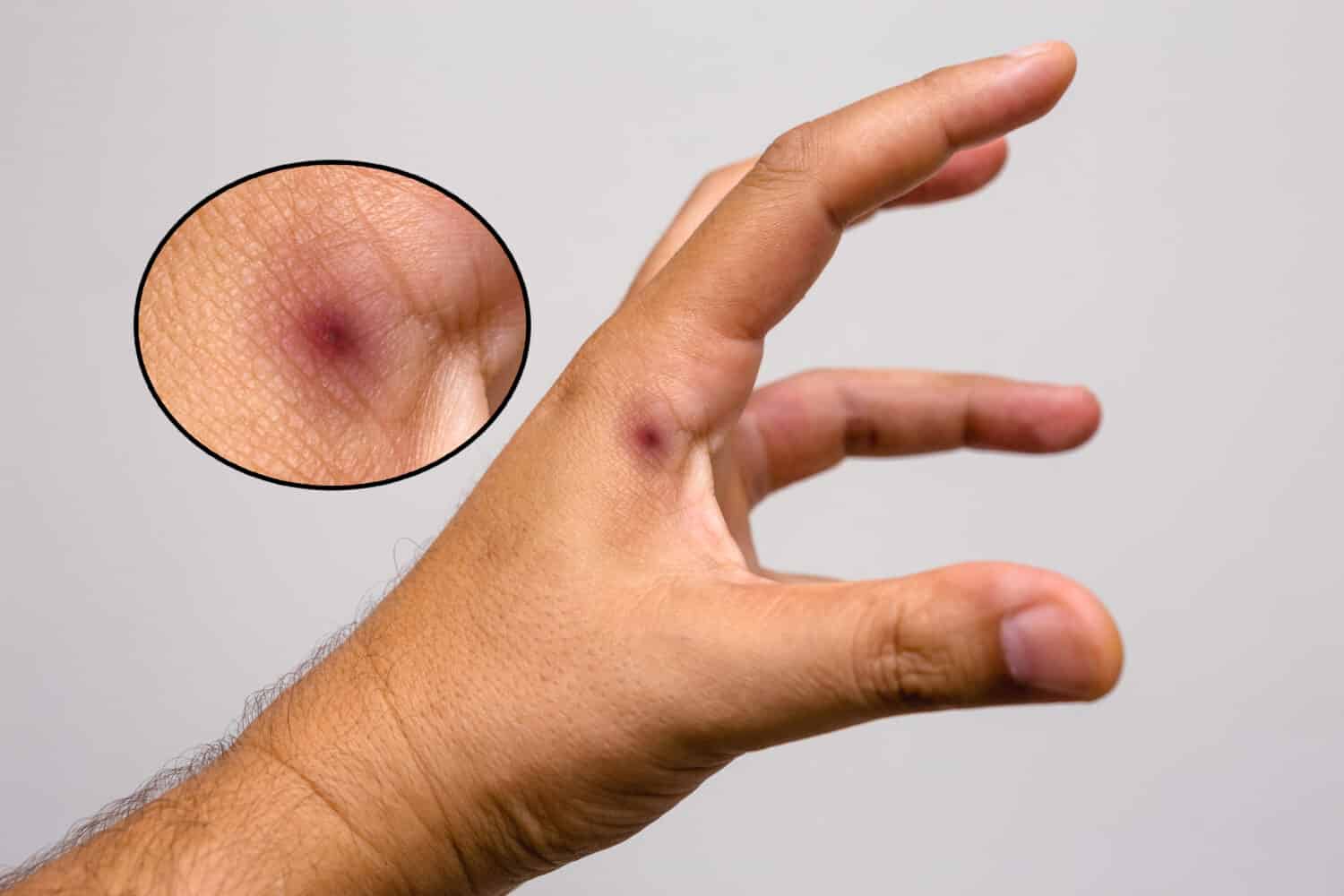 foto di una puntura di scorpione nella mano di una persona. Puntura di scorpione, veleno di scorpione. Tityus serrulatus, noto come scorpione giallo, è un tipico del sud-est, del Midwest e del nord-est del Brasile