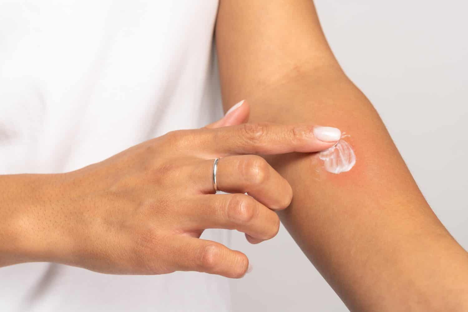 Reazione allergica, prurito, allergia, concetto di dermatite.  Primo piano della donna che applica crema o unguento sulla pelle gonfia dopo punture di zanzara, isolato su sfondo grigio studio. 