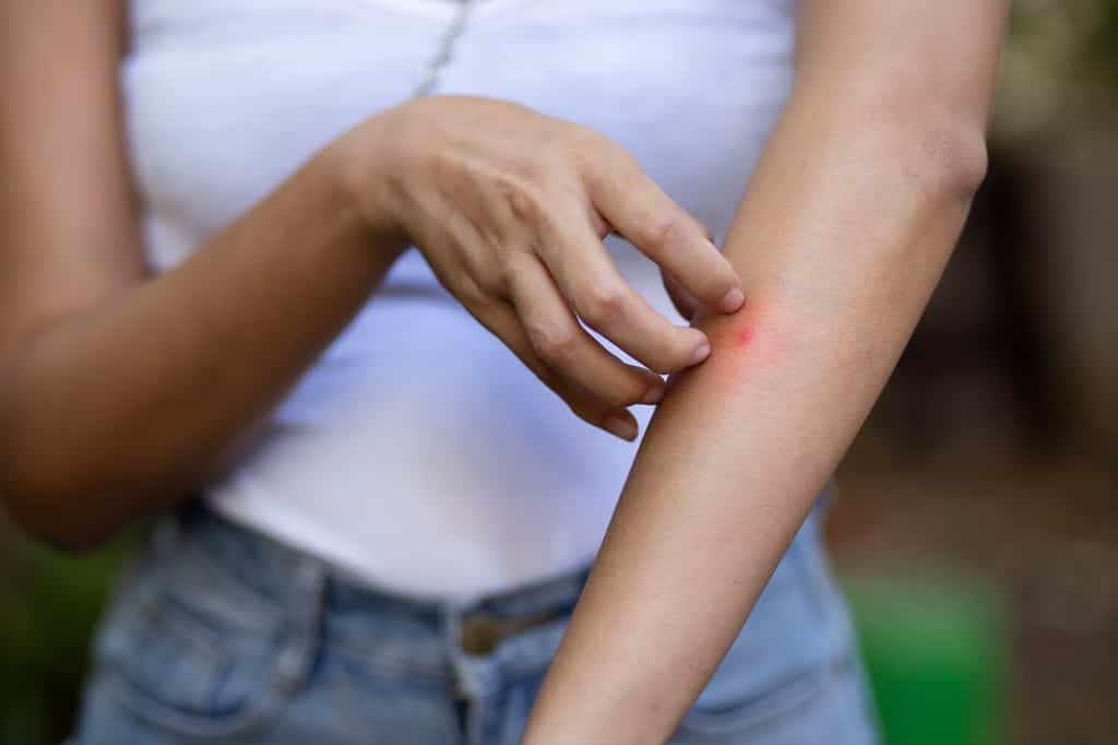 Donna asiatica che si gratta la pelle del braccio, immagine del concetto di assistenza sanitaria della puntura di zanzara, infiammazione del derma allergico, infezione da funghi, malattia dermatologica, malaria, dengue, infezione da virus della zanzara tropicale