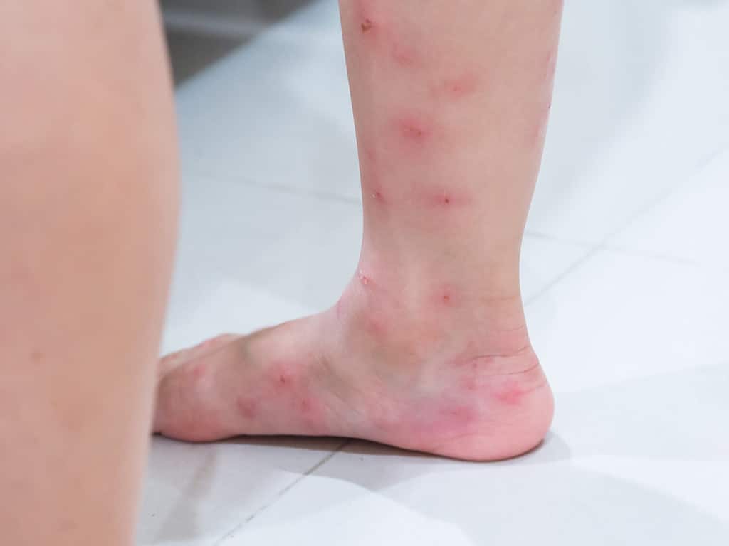 Vesciche rosse sulle gambe di una ragazza dopo il morso delle formiche (Solenopsis geminata, formica del fuoco tropicale).