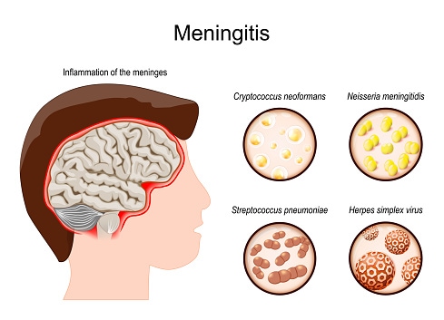 Meningite. Cervello umano con infiammazione delle meningi e degli agenti patogeni