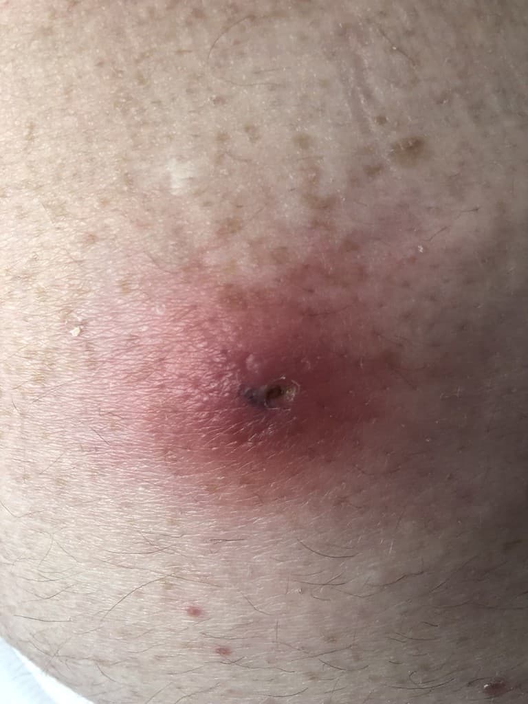 Papule formate dai vermi del mango, le larve delle mosche del mango.  Quando le larve saranno completamente cresciute, la papula scoppierà e libererà i vermi.